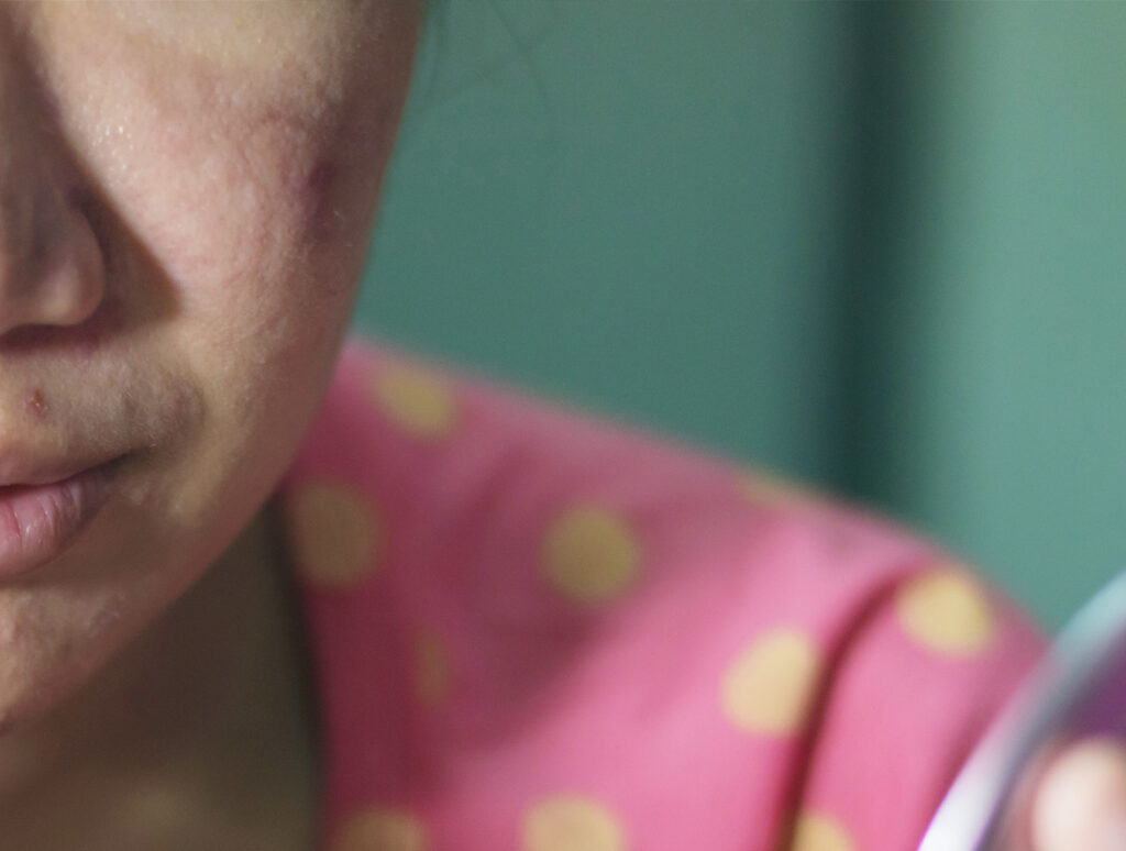 rosacea informatie