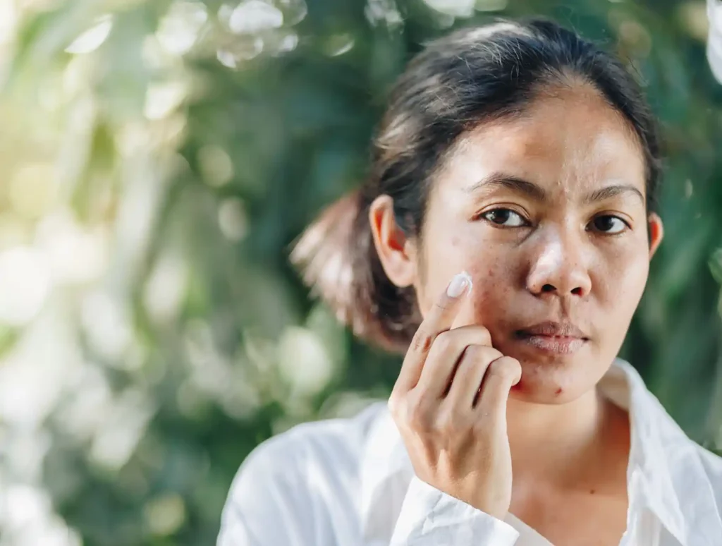 acne make up gebruiken