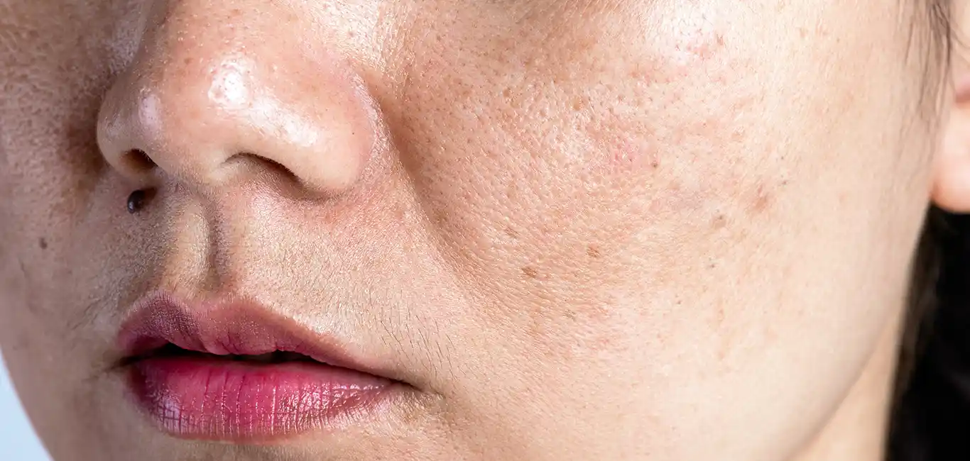 Niacinamide Pigmentatie