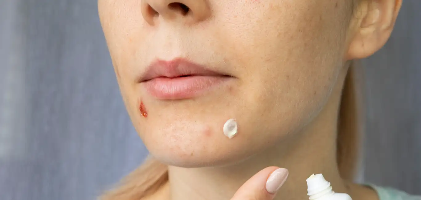 Salicylzuur Acne