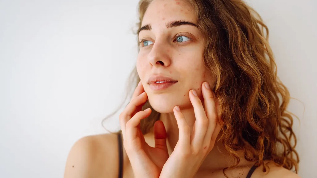 Acne Benzoylperoxide Salicylzuur