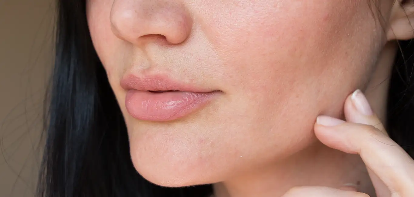 acne puistjes purging