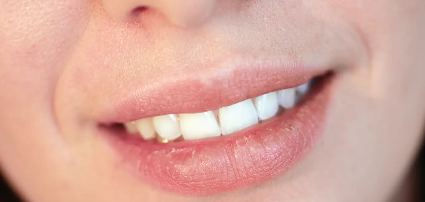 droge lippen