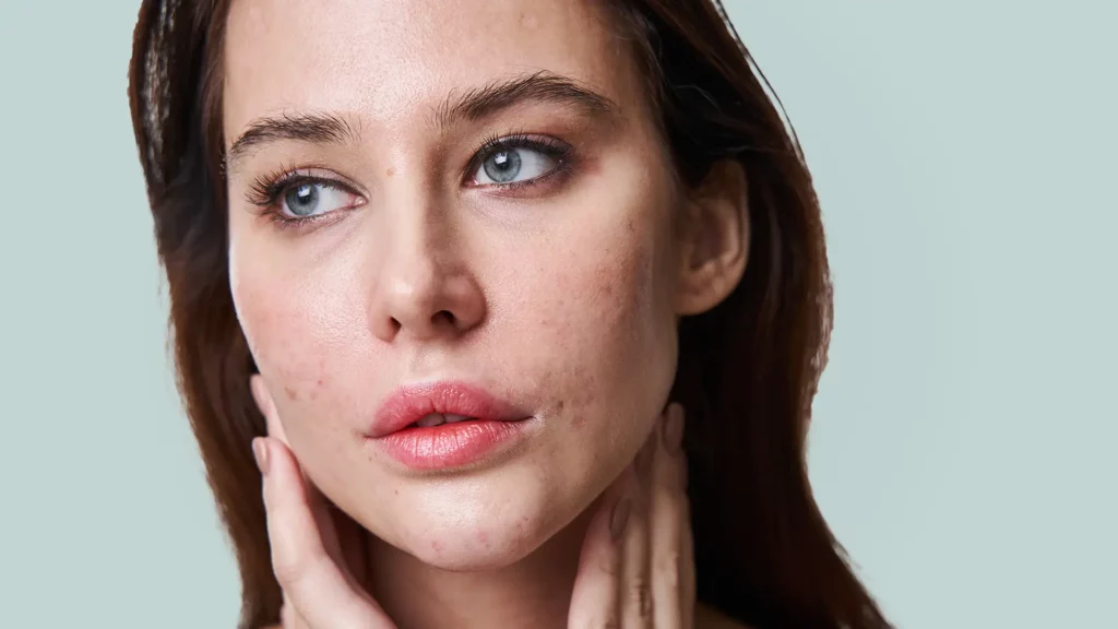 4 beste serums acne