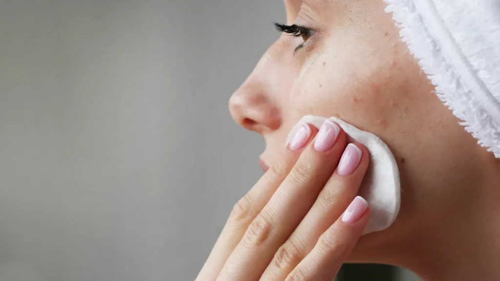 Blog - Salicylzuur - Acne