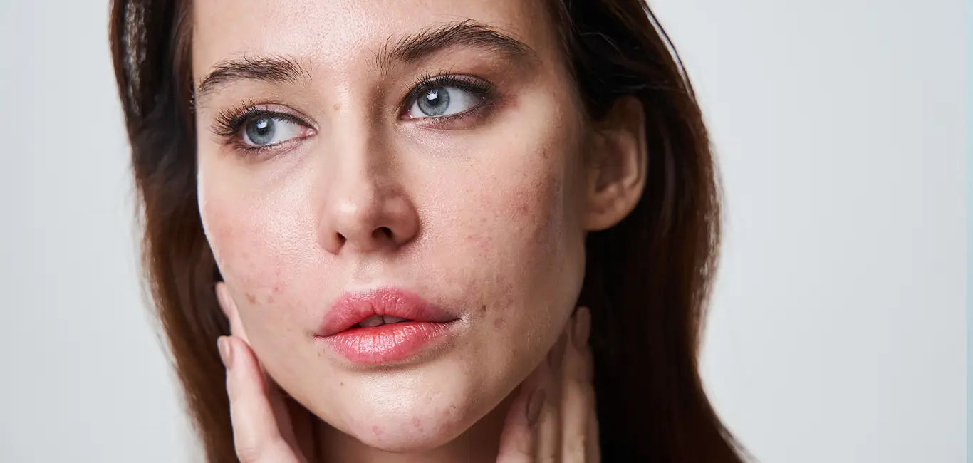 Salicylzuur Acne welke Skincare producten
