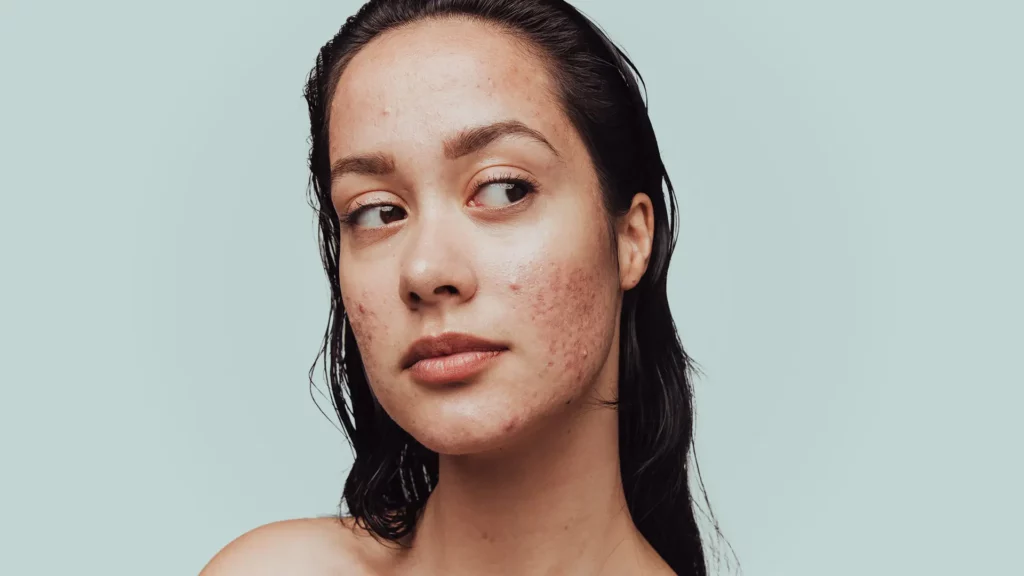 beste dagcrème acne