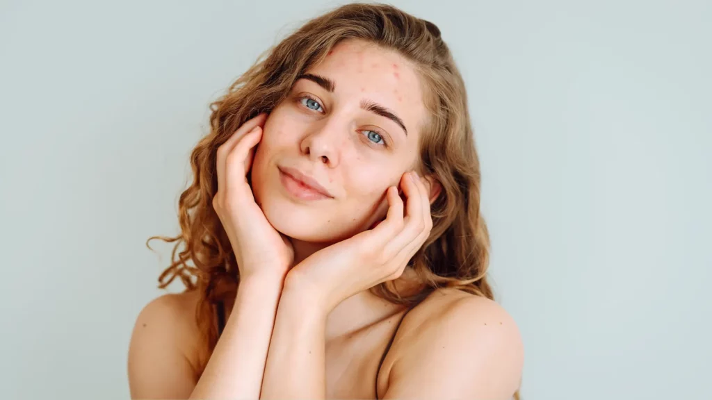 Waarom Skincare Helpt bij Acne